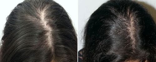 Плазмотерапия для лечения волос