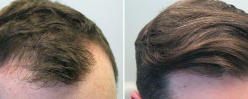 Микроигольчатый RF-лифтинг для роста волос