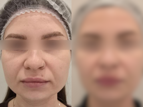 Ботулинотерапия при бруксизме — клинический случай | Когда начинать инъекции?