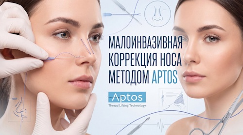 Безоперационная ринопластика Aptos: подъем кончика и коррекция формы носа