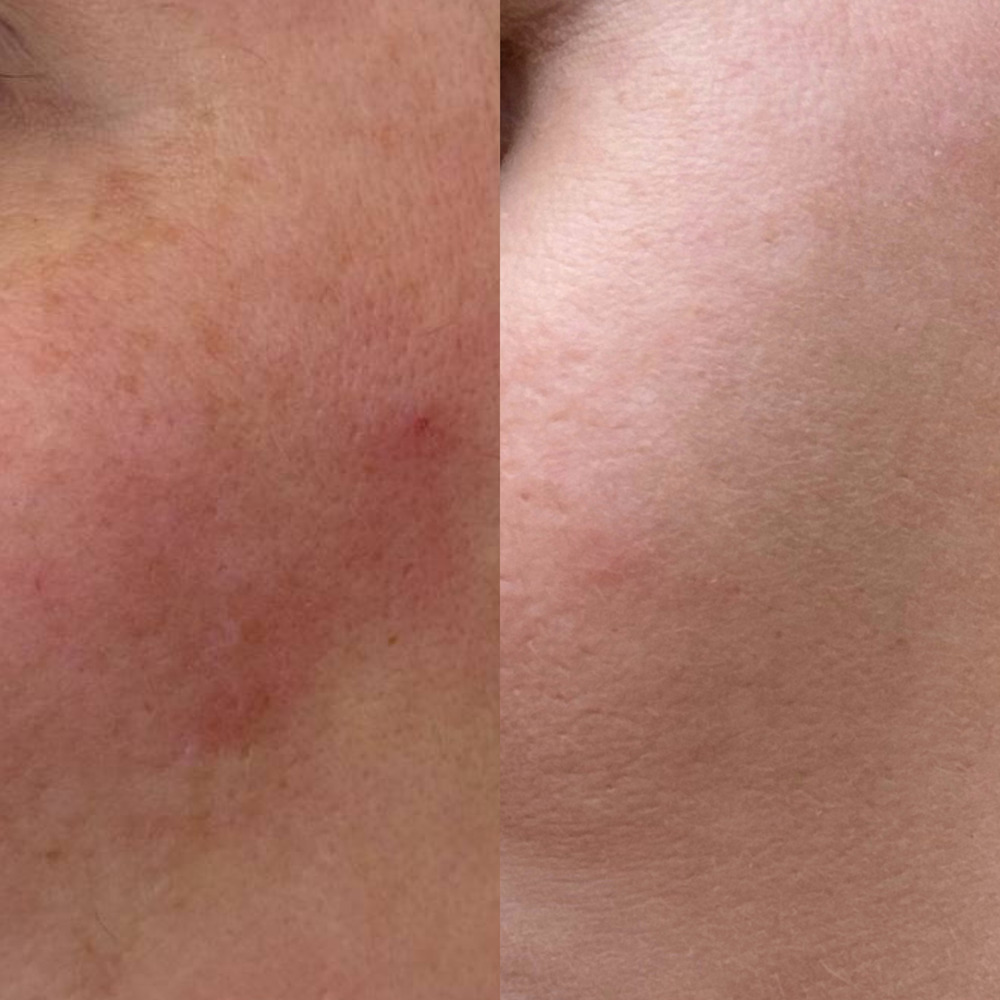 Биоревитализация