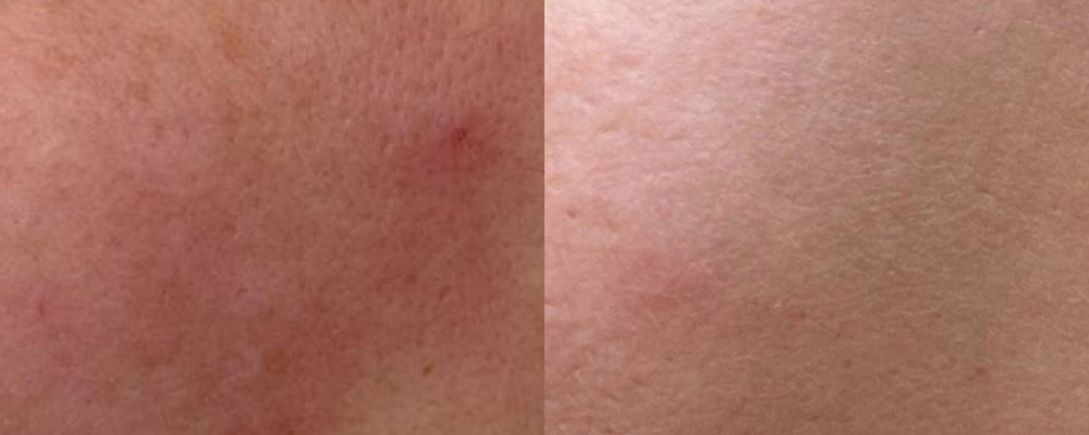 Биоревитализация