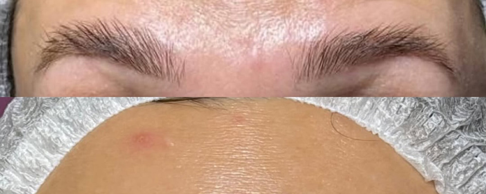 Ботулинотерапия