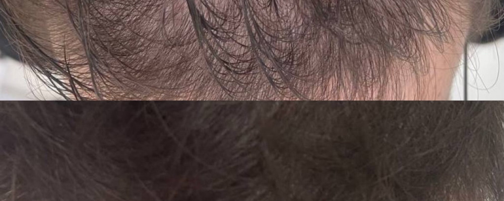 Лечение алопеции