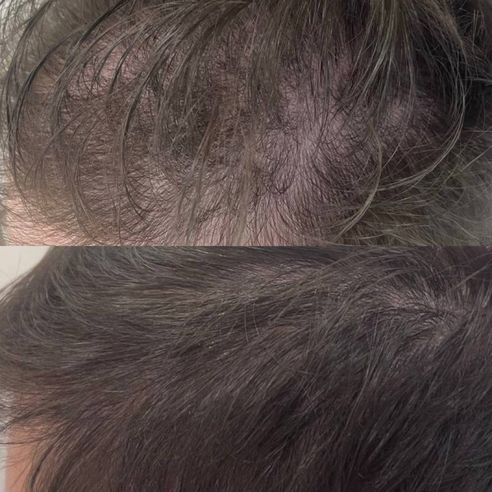 Лечение алопеции