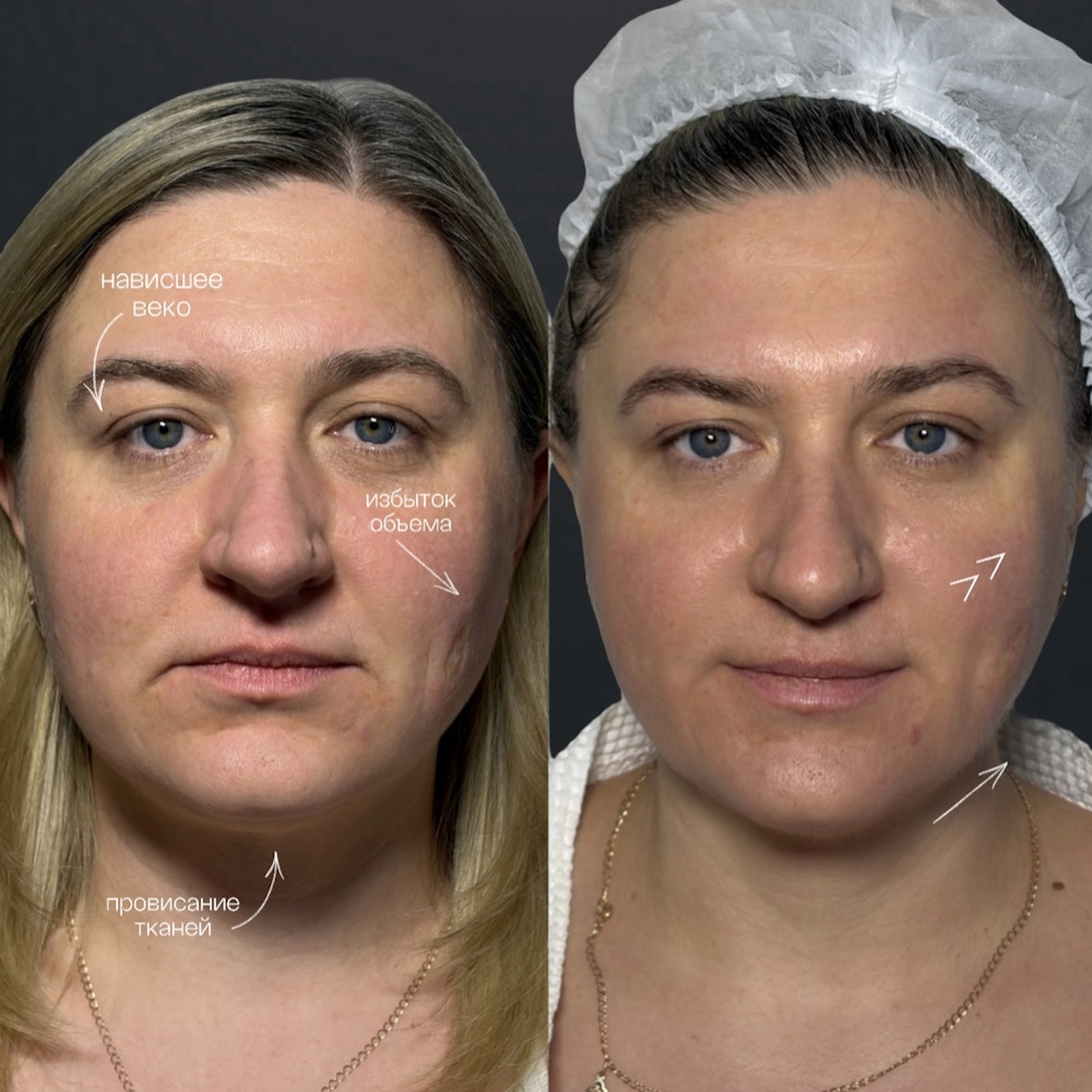 Лифтинг и коррекция овала лица