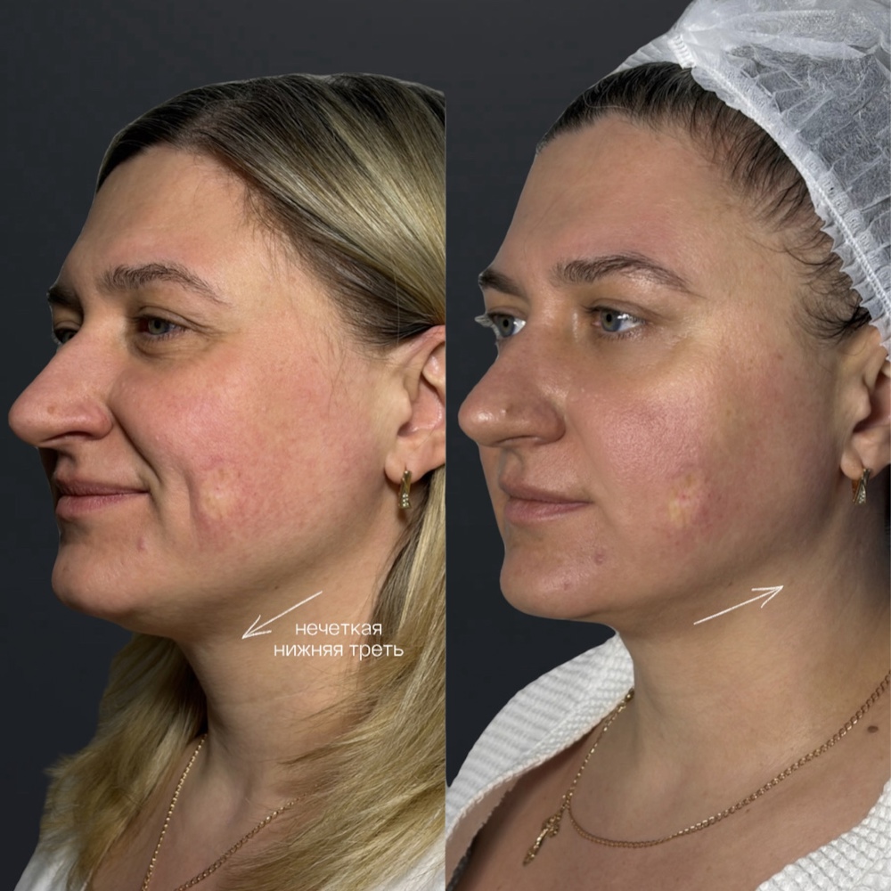 Лифтинг и коррекция овала лица