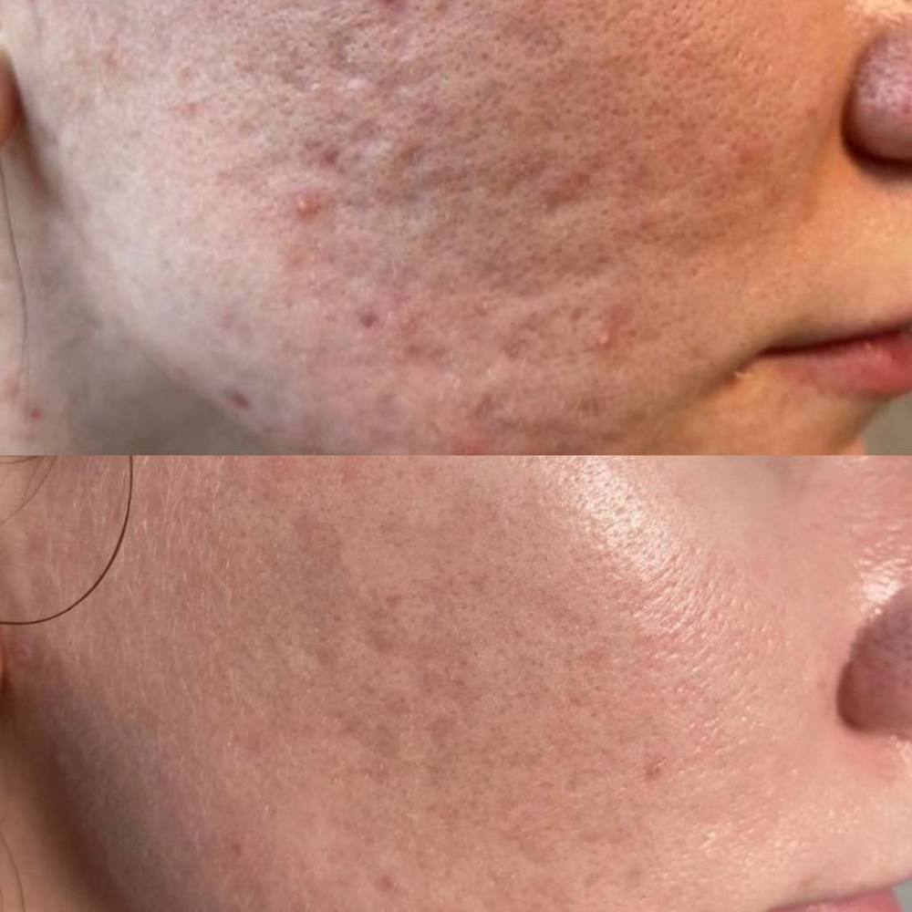 Субцизия рубцов постакне