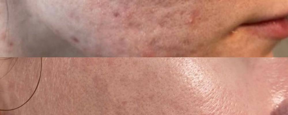 Субцизия рубцов постакне