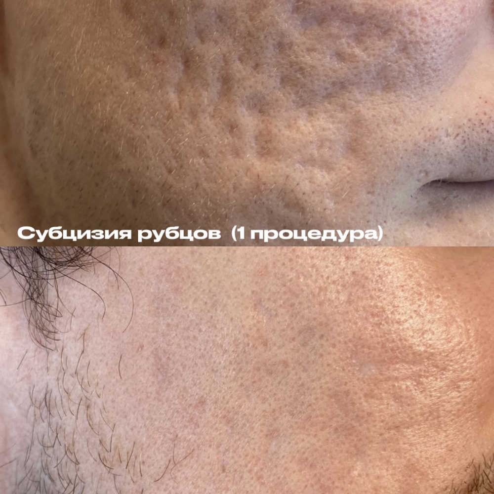 Субцизия рубцов постакне