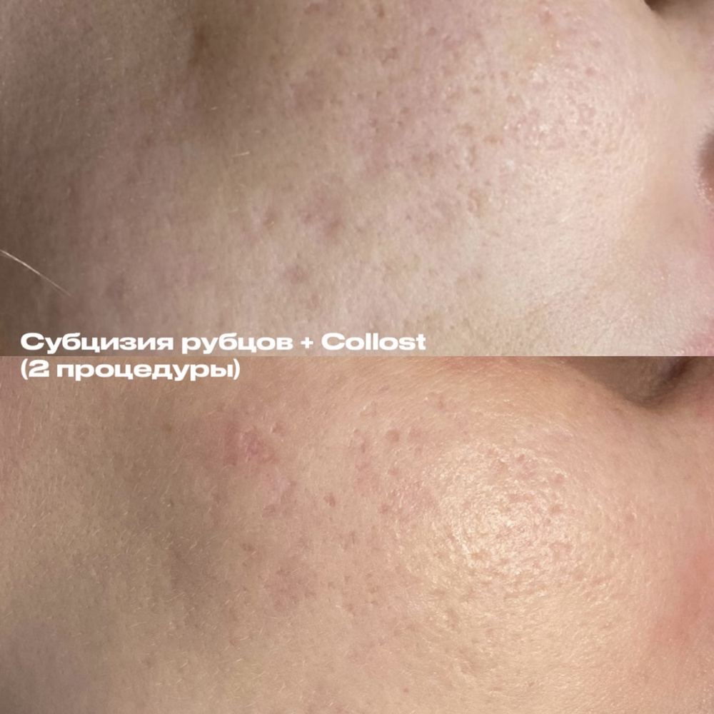 Субцизия рубцов постакне