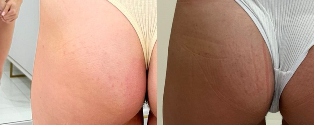 Коррекция ягодиц