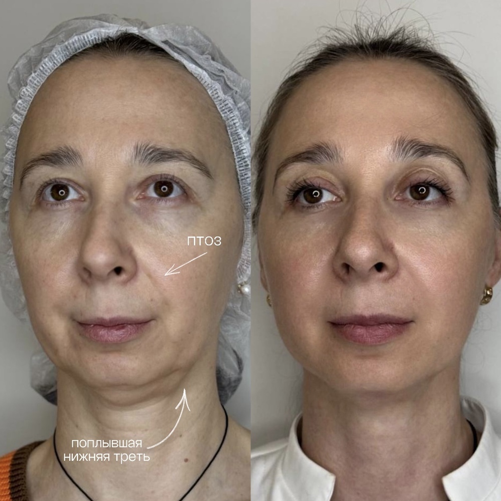 Комплексная коррекция лица