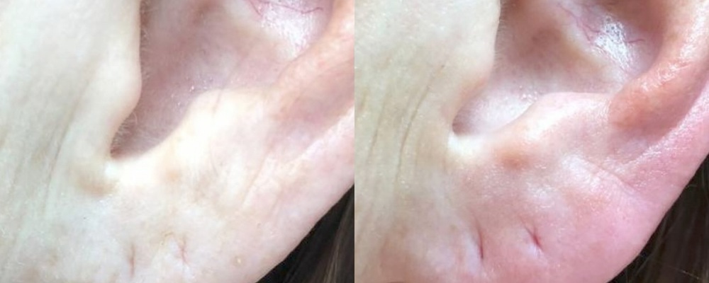 Восполнение объёма мочек ушей