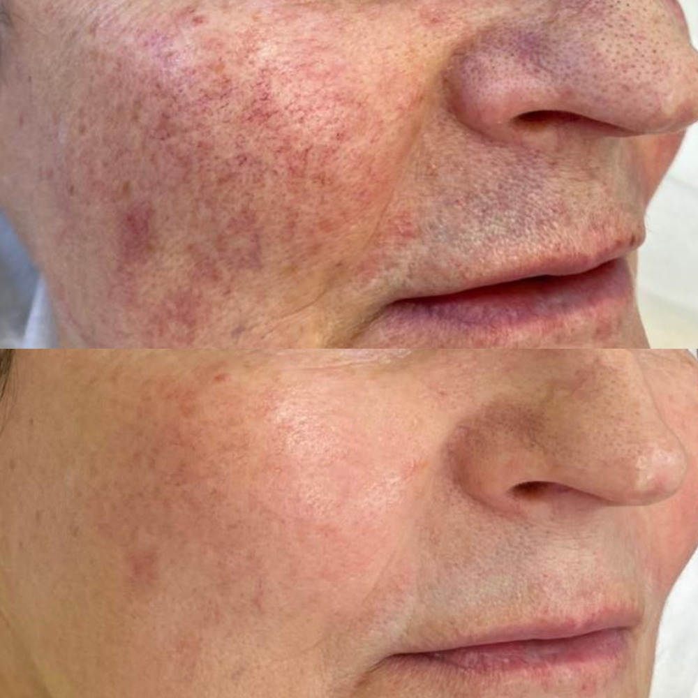 Лечение сосудистых патологий