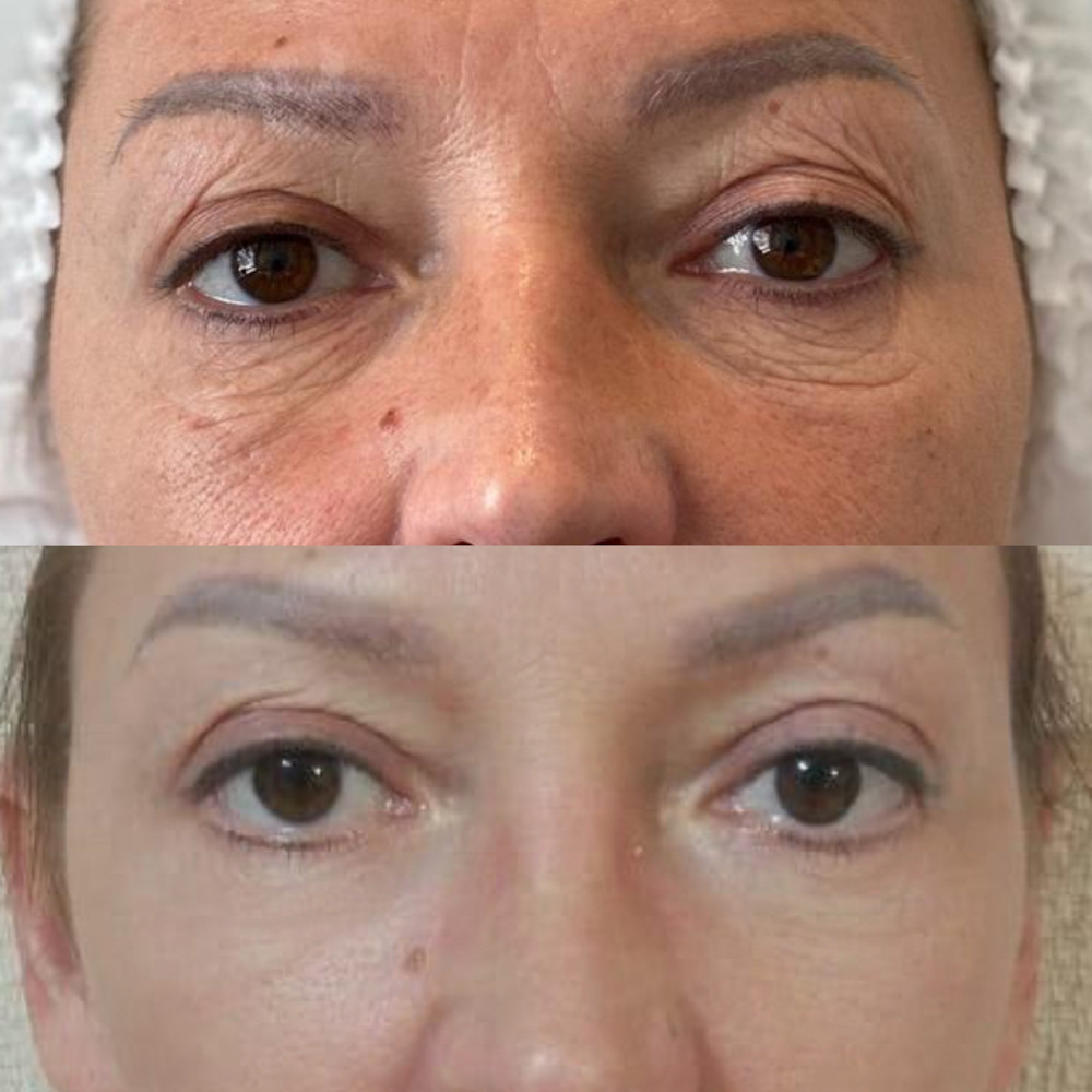 Безоперационная блефаропластика 