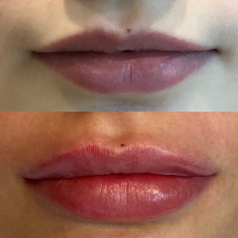 Коррекция и увеличение губ