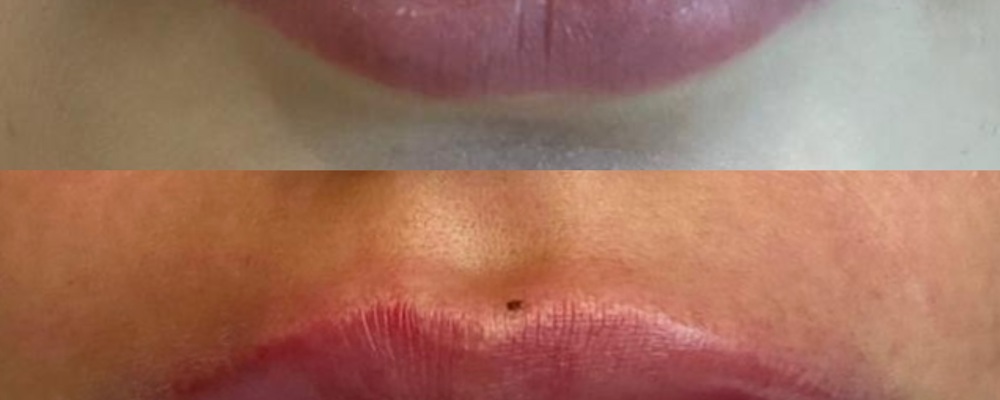 Коррекция и увеличение губ
