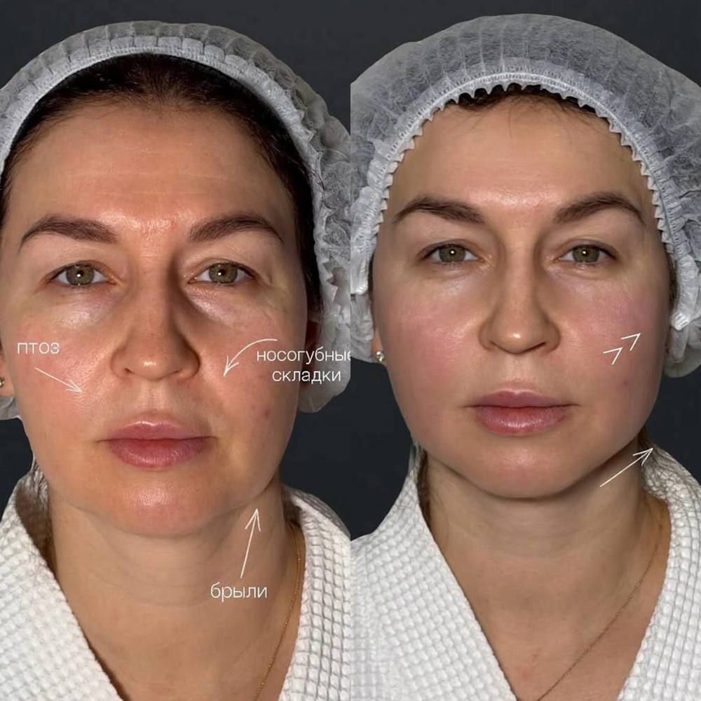 Комплексное омоложение лица