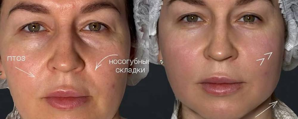 Комплексное омоложение лица