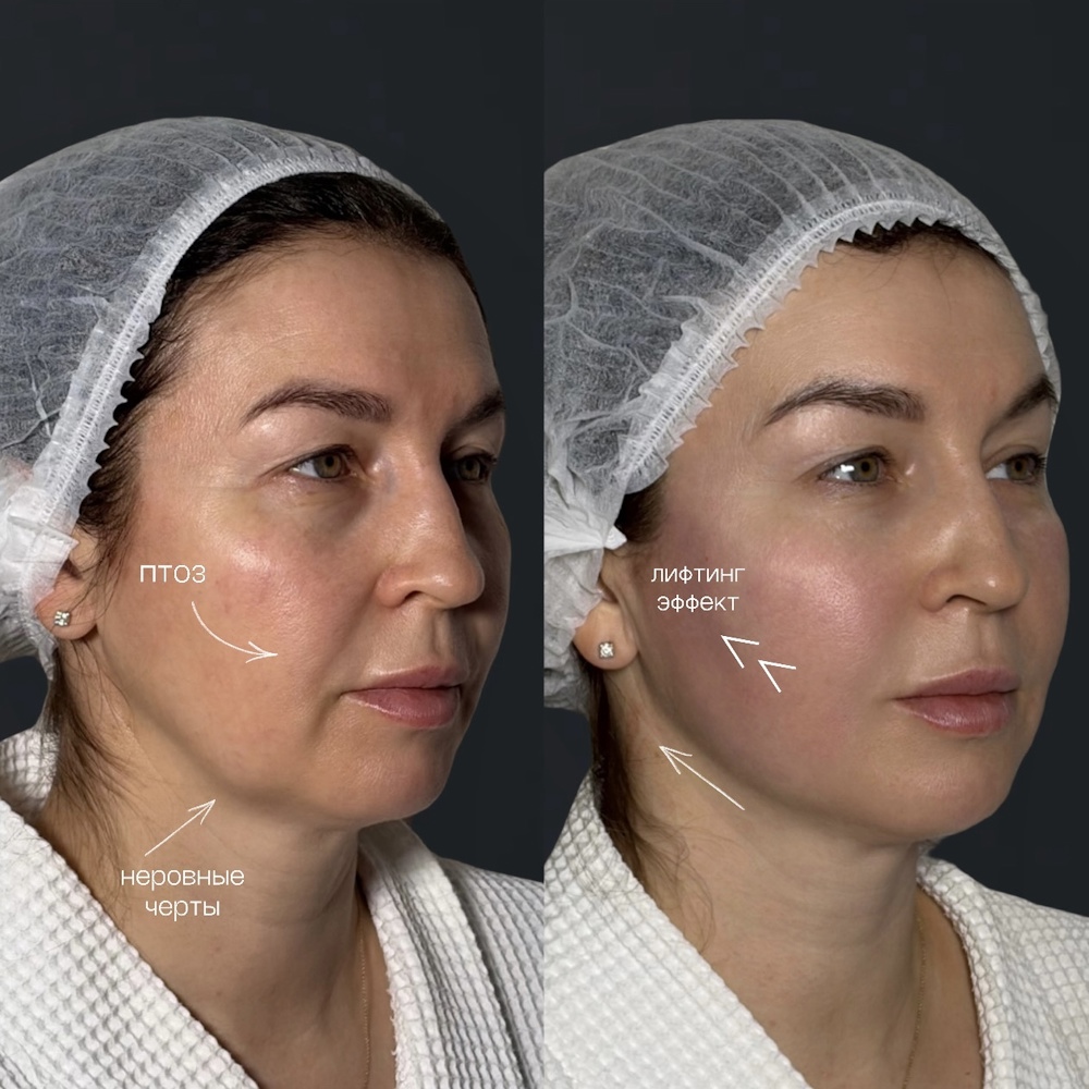 Комплексное омоложение лица