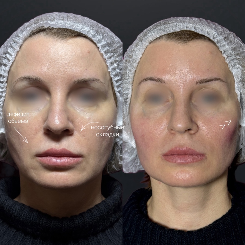 Векторный лифтинг препаратом Radiesse