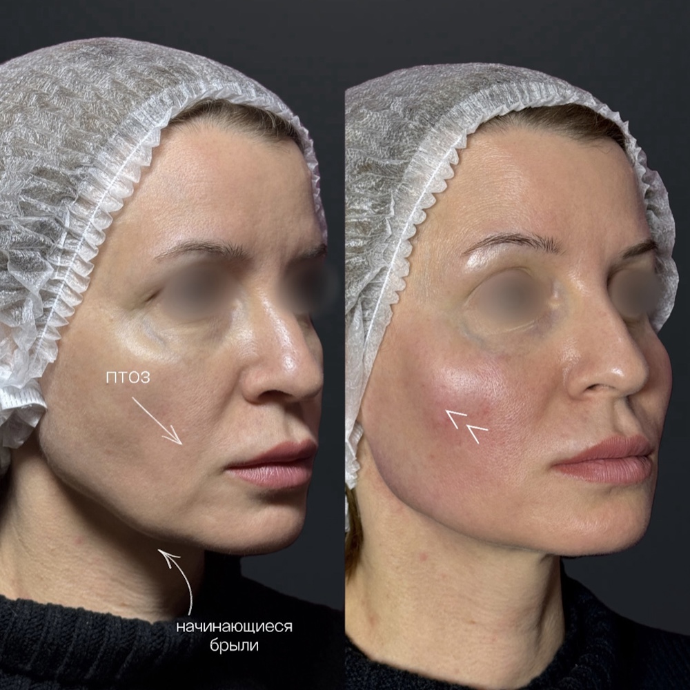 Векторный лифтинг препаратом Radiesse