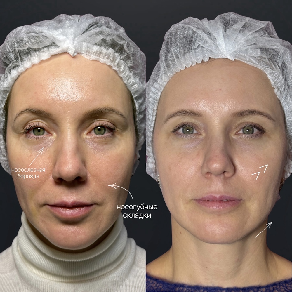 Контурная пластика full face