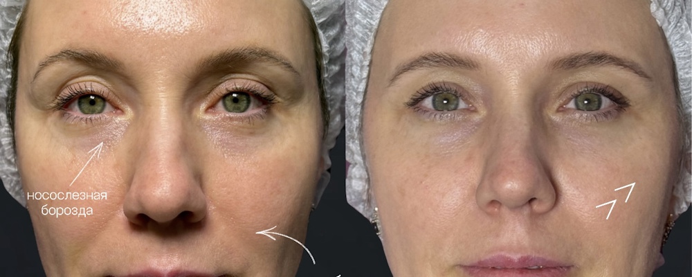 Контурная пластика full face