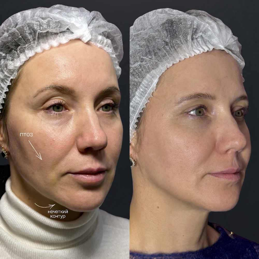 Контурная пластика full face