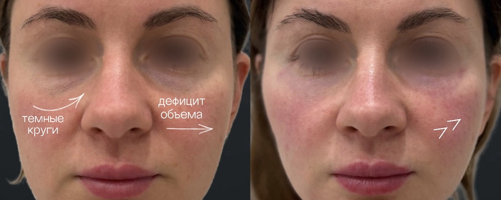 Контурная пластика лица