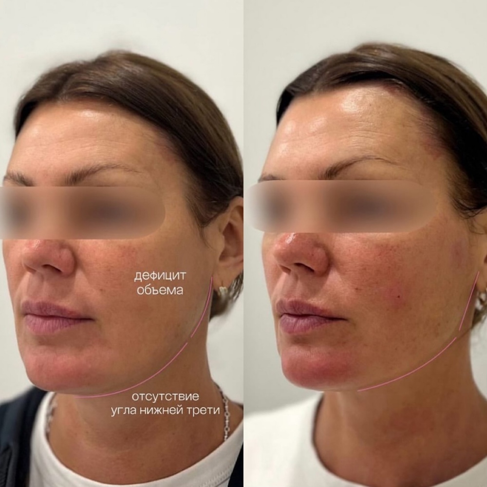 Контурная пластика лица