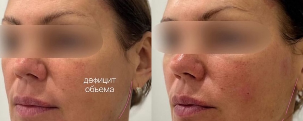 Контурная пластика лица