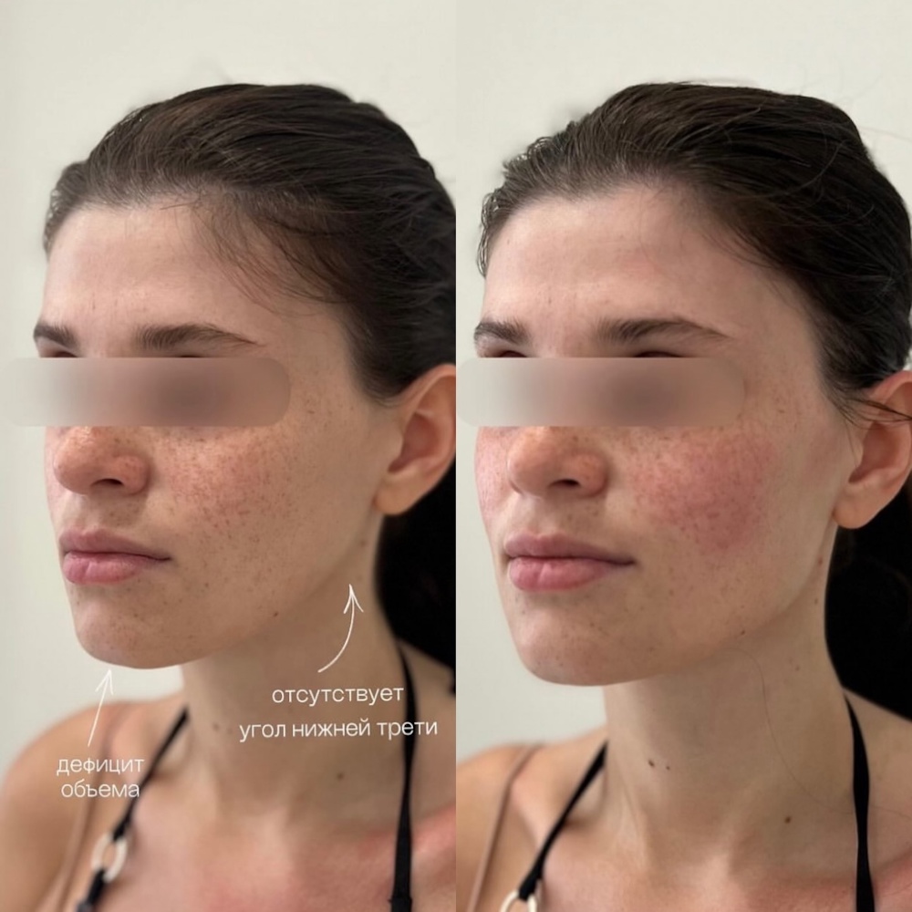 Коррекция лица