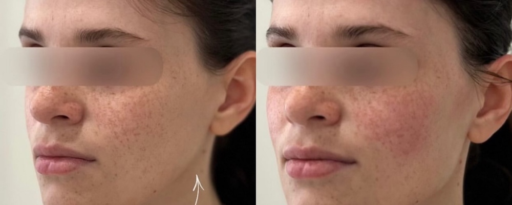 Коррекция лица