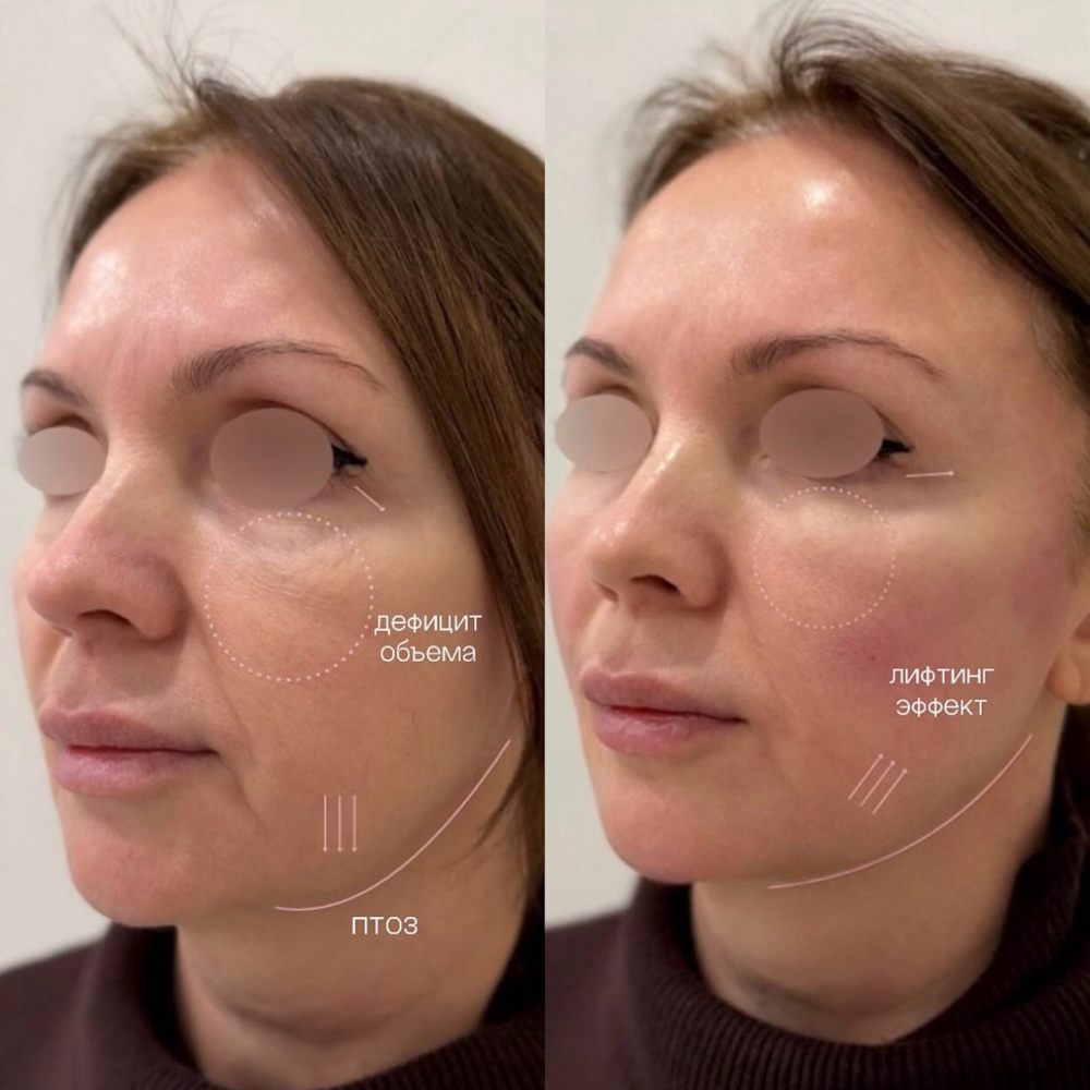 Контурная пластика лица