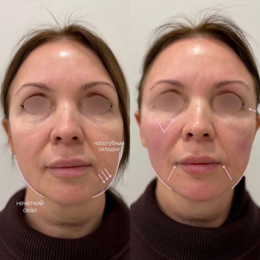 Контурная пластика лица