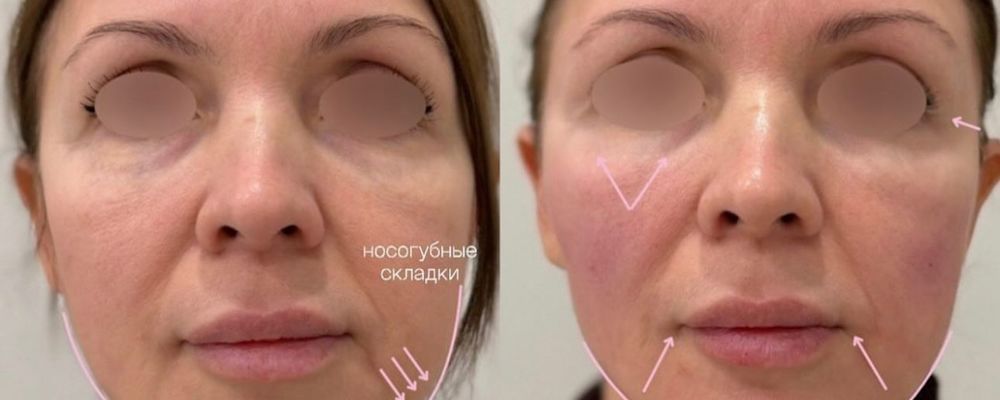 Контурная пластика лица