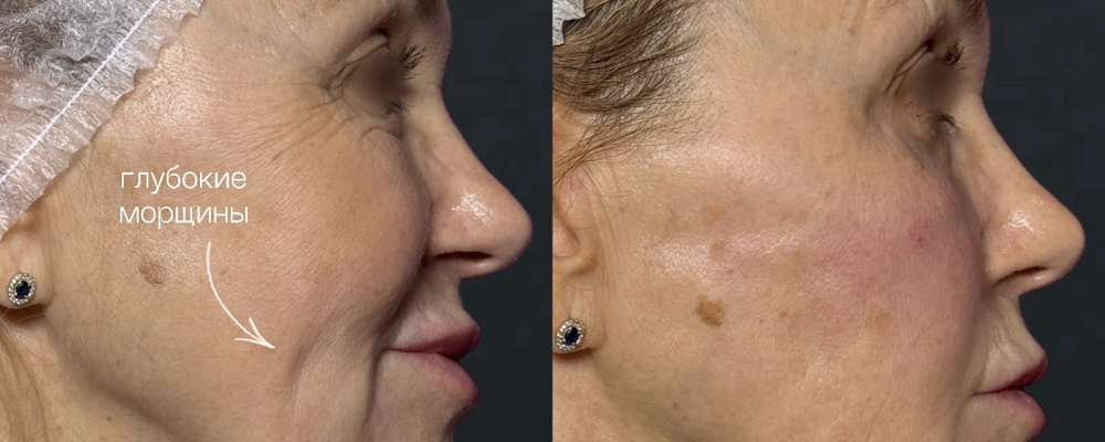 Контурная пластика лица