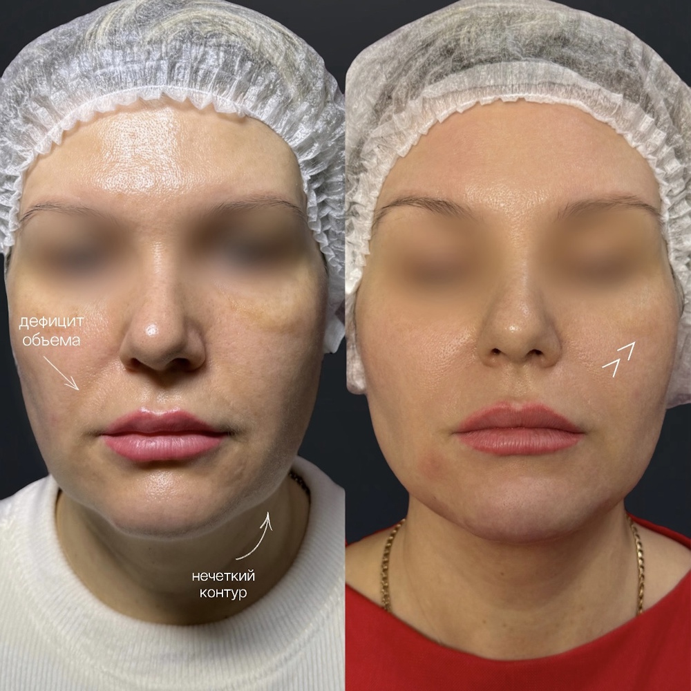 Контурная пластика лица