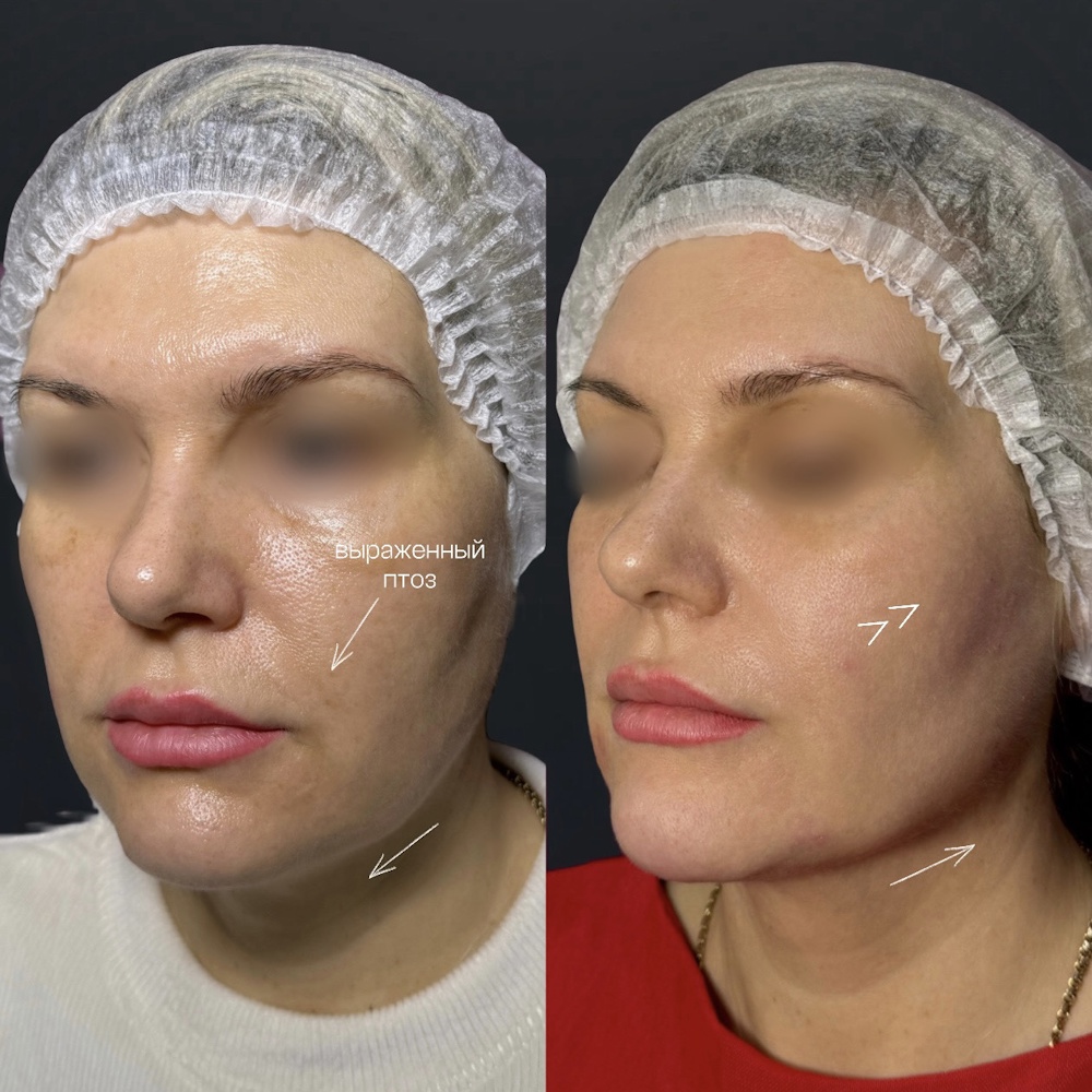 Контурная пластика лица