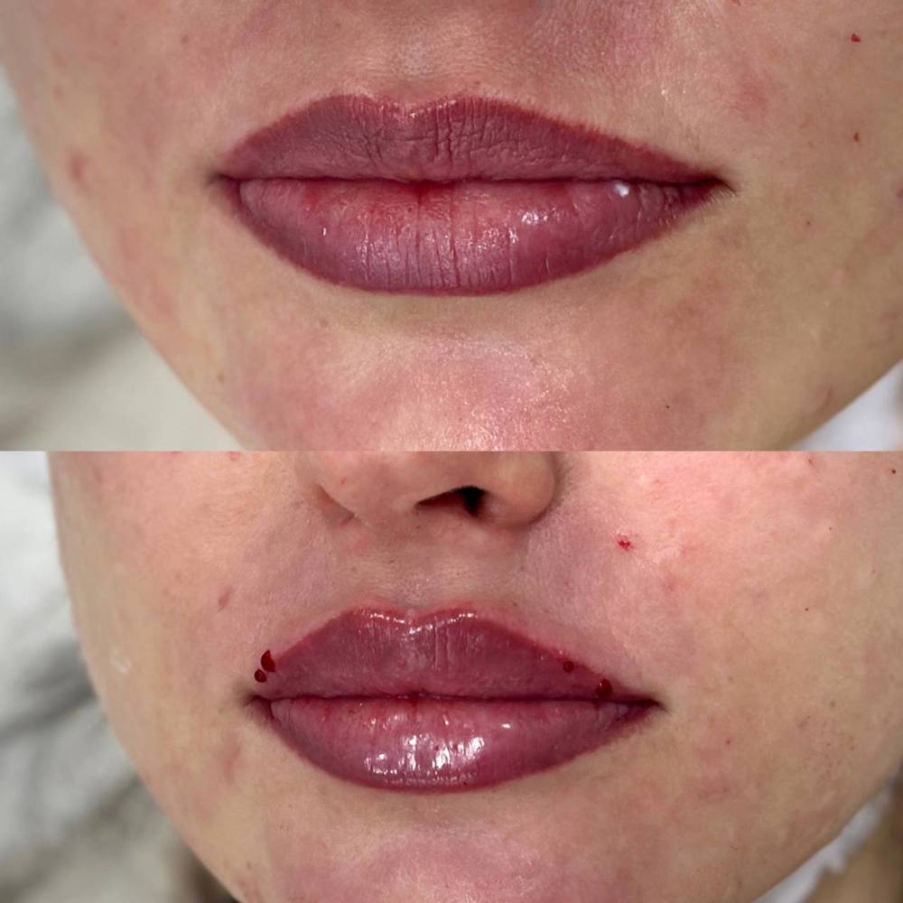  Контурная пластика губ