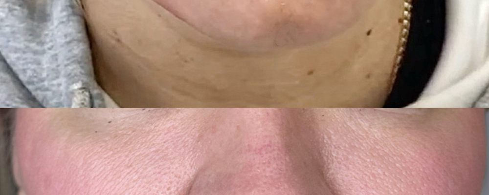 Комплексная коррекция лица