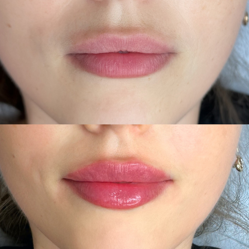 Коррекция и увеличение губ