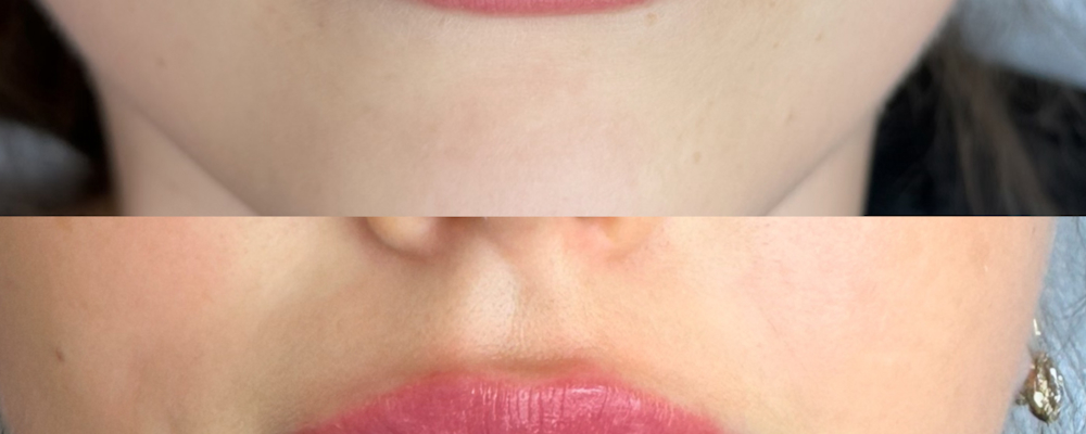 Коррекция и увеличение губ