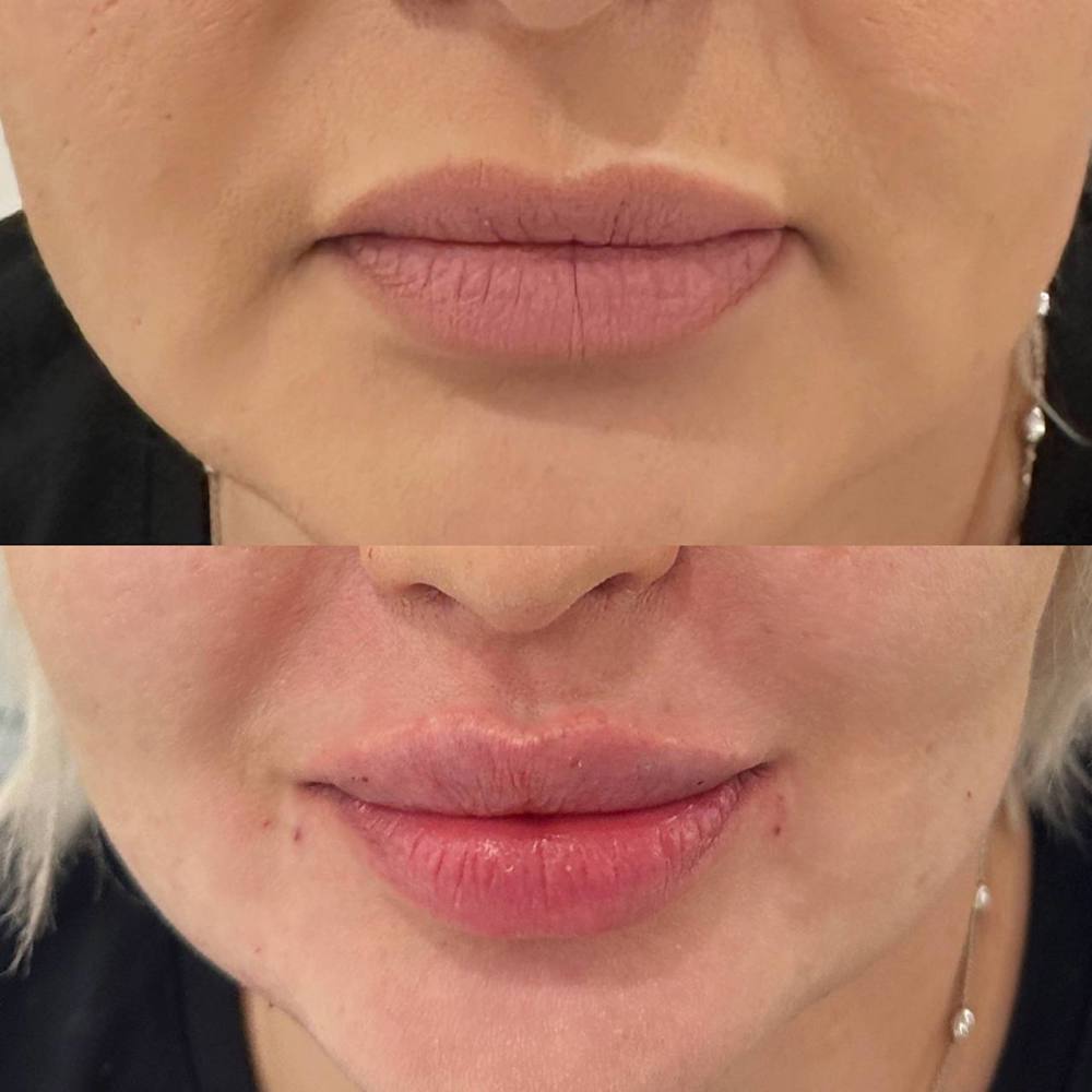 Контурная пластика губ