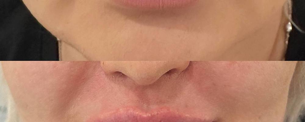 Контурная пластика губ