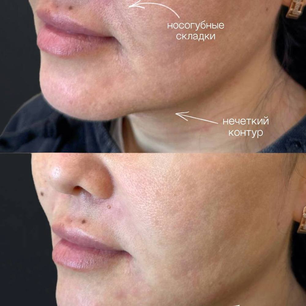 Контурная пластика нижней трети лица