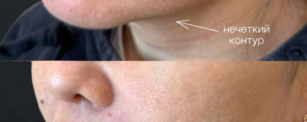 Контурная пластика нижней трети лица