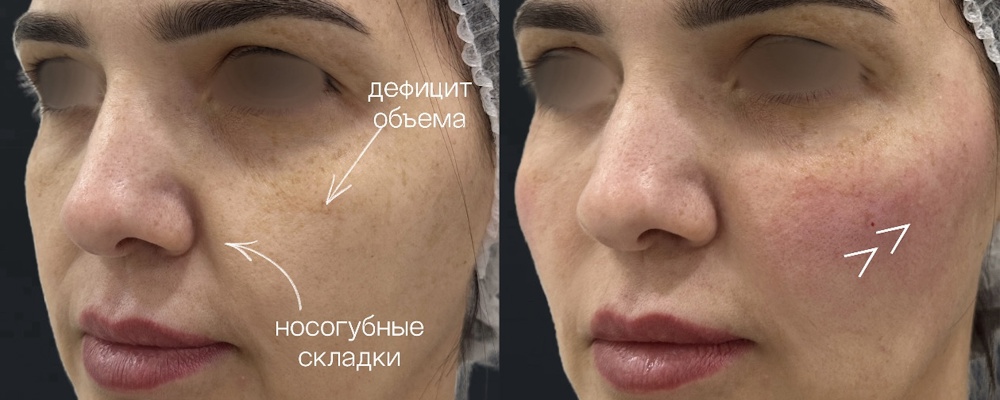 Коррекция нижней трети лица